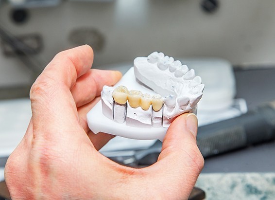 A closeup shot of a dental bridge held in a plaster model