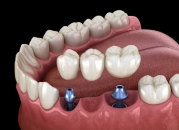 Animated dental bridge supported by two dental implants