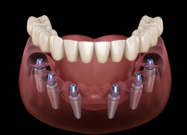 Animated implant denture supported by six dental implants