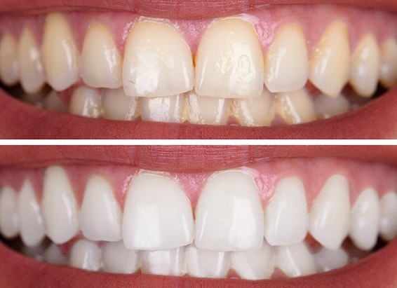 Closeup before/after pictures of a whitened smile