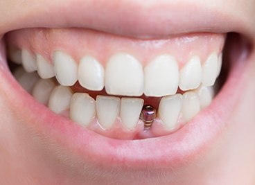 Closeup of a dental implant