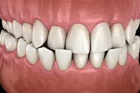 Illustration of crossbite