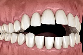 Illustration of open bite