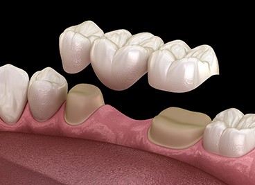 A 3D illustration of a traditional dental bridge