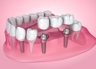 A 3D illustration of an implant dental bridge 