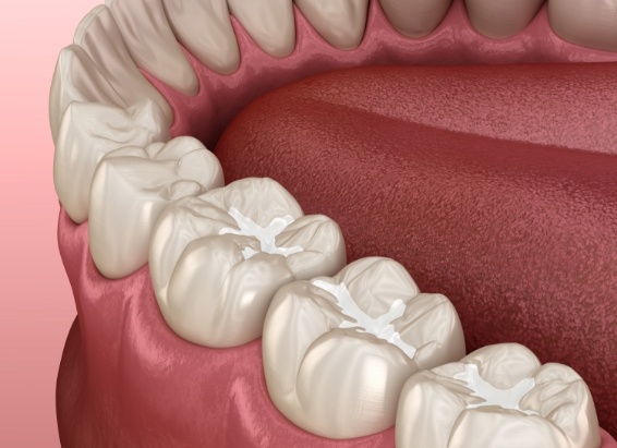 Animated row of teeth with tooth colored fillings