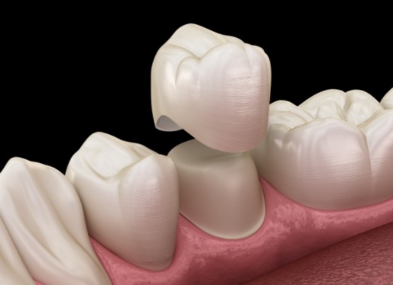 Animated dental crown being fitted over a tooth