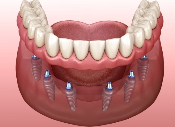 Animated implant denture replacing all of the missing lower teeth