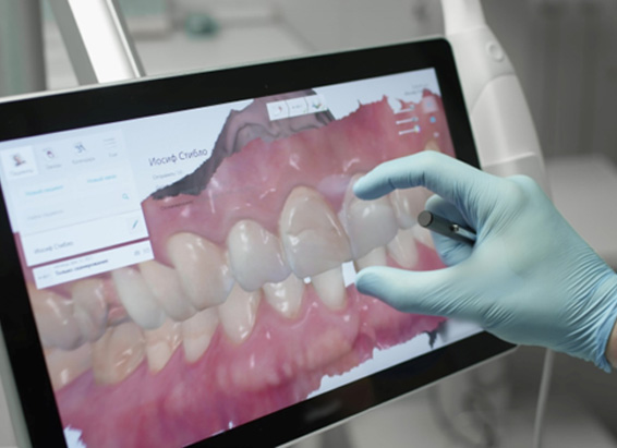 Digital scan of York patient’s tooth for CEREC crown 