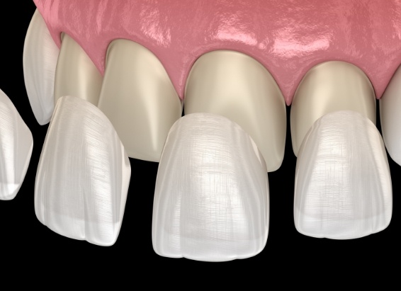 Animated dental veneers being placed over a row of teeth