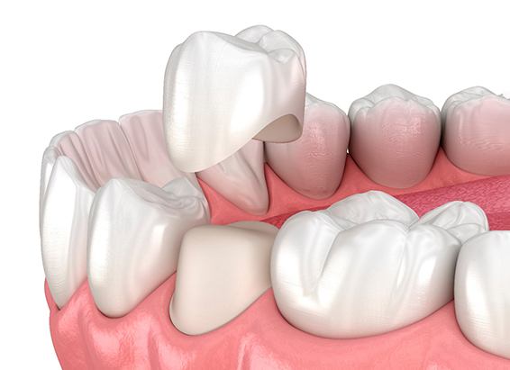 A single dental crown
