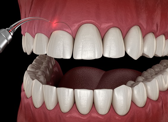 a computer illustration showing gum recontouring with a laser