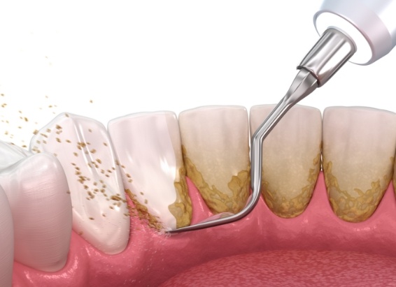 Animated dental instrument removing plaque from teeth