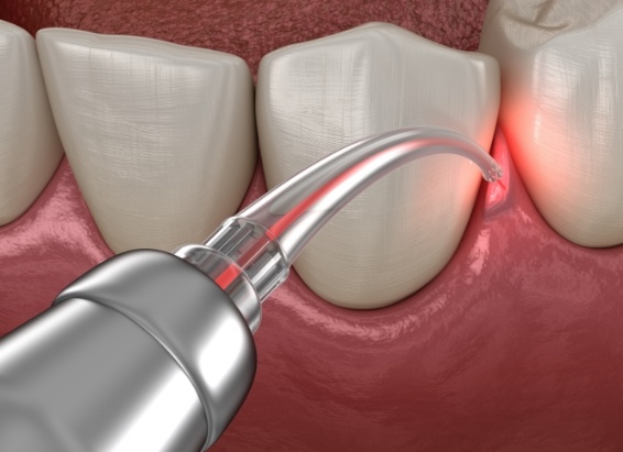 Animated soft tissue laser treating gum disease