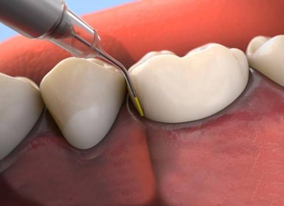 Animated dental tool applying antibiotic to the gums