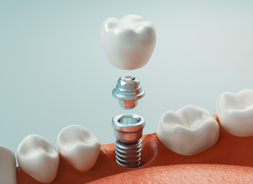 A 3D rendering of the parts of a dental implant