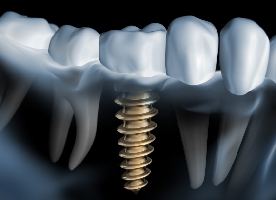 Animated x ray of a person with dental implants in York
