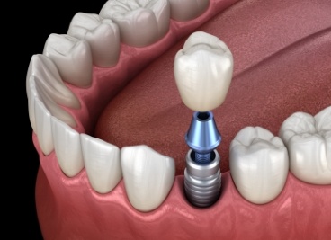 Animated dental implant with dental crown