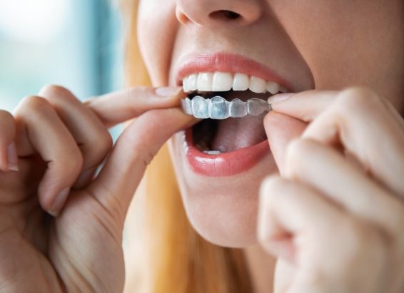 Close up of woman placing Invisalign clear aligner in her mouth