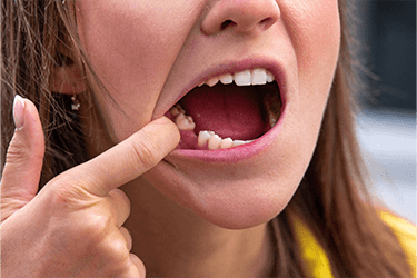 Woman missing a tooth