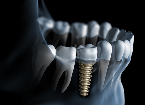 Animated x ray of a person with a dental implant