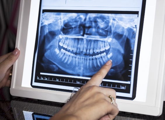 Dentist pointing to all digital dental x rays
