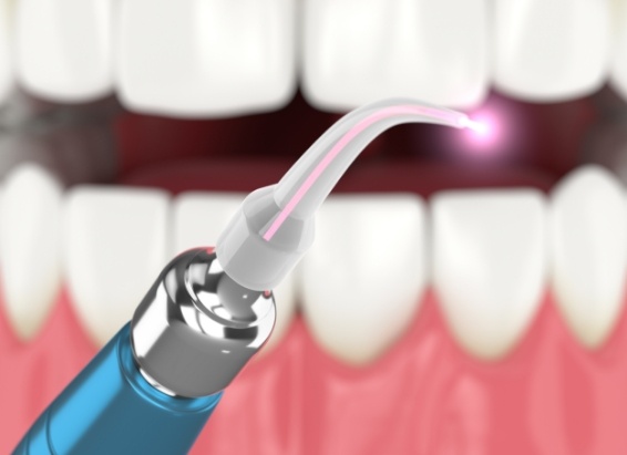 Animated soft tissue laser in front of mouth