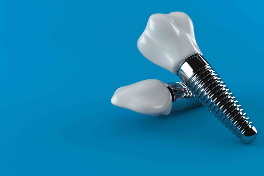 Illustration of a dental implant